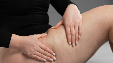 Come combattere la cellulite prima dell’estate: 3 step, risultati al top